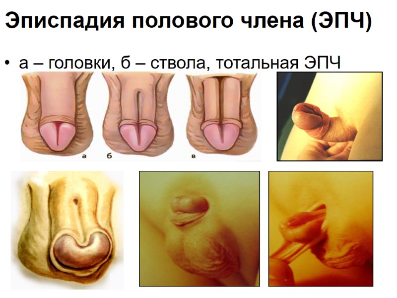 Эписпадия полового члена (ЭПЧ)  а – головки, б – ствола, тотальная ЭПЧ